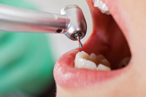 Best Emergency Treatment for Dental Infections or Abscesses in Carteret, NJ